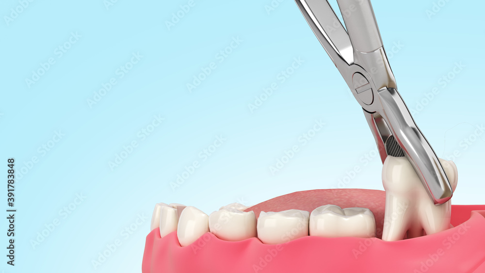 tooth clamped in medical extraction forceps dental services concept 3d render on blue gradient