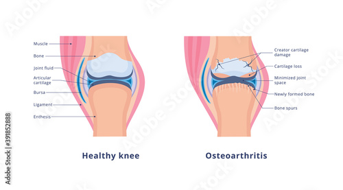 Vector banner with medical anatomy with knee osteoarthritis and normal joint photo