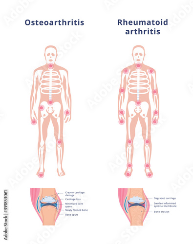 Banner of osteoarthritis and rheumatoid arthritis flat vector illustration.