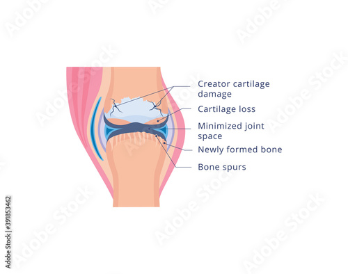 Knee joint damage with osteoarthritis, flat vector illustration isolated.