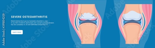 Medical banner with osteoarthritis knee and healthy joint a vector illustration.