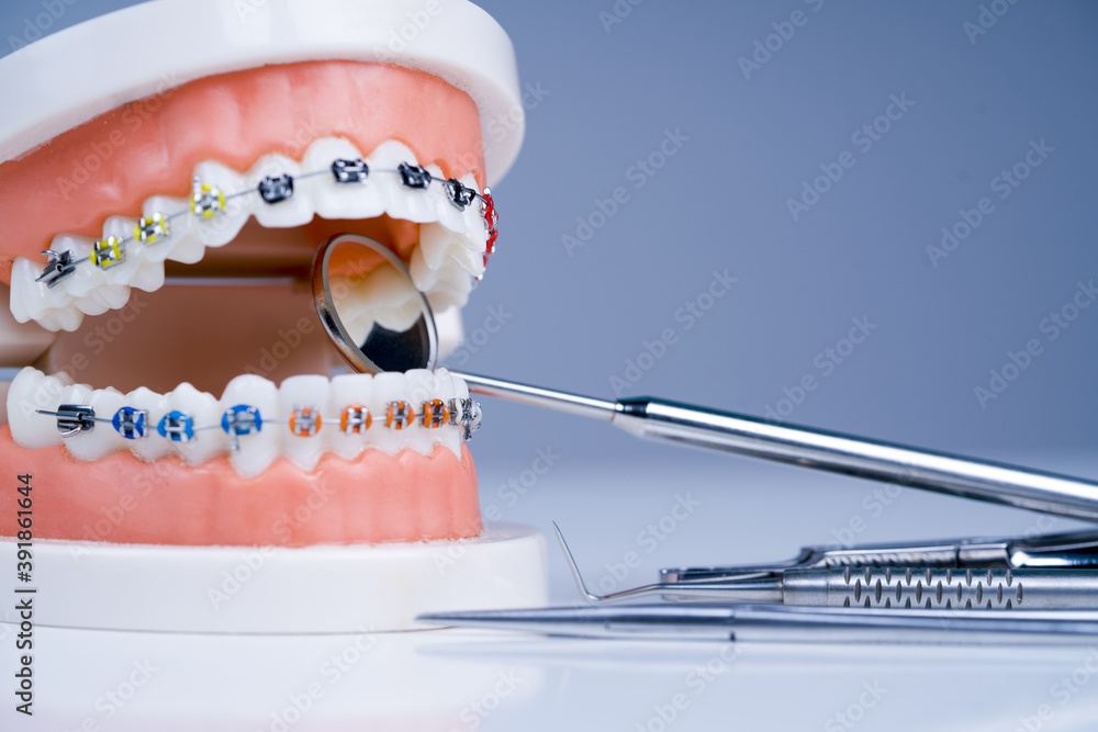 Orthodontics treatment. Orthodontic model and dentist tool - demonstration teeth model of varities of orthodontic bracket or brace. - obrazy, fototapety, plakaty 