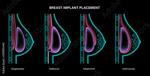 Breast Implant Concept
