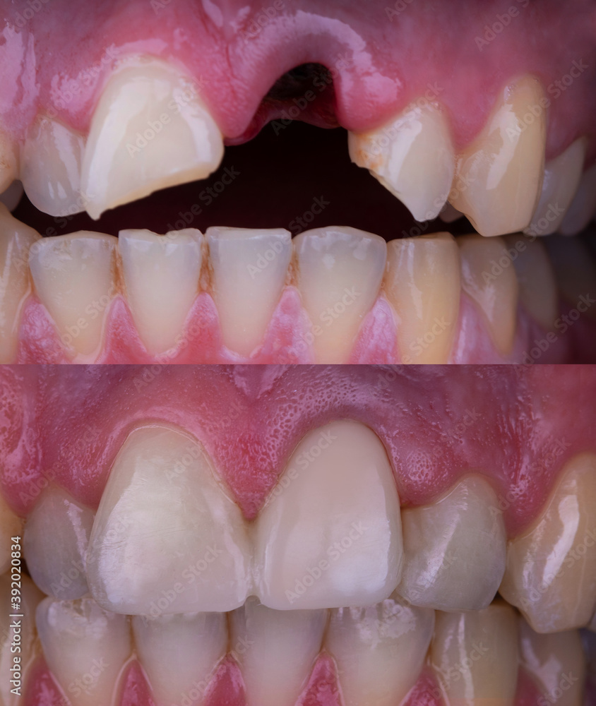 Tooth Restoration Before And After Treatment