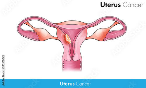 Uterine Cancer of female reproductive organ vector design concept in white background 