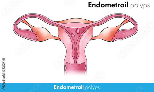 Endometrial Polyps is disease condition of non cancer growth in female uterus vector concept diagram in white background