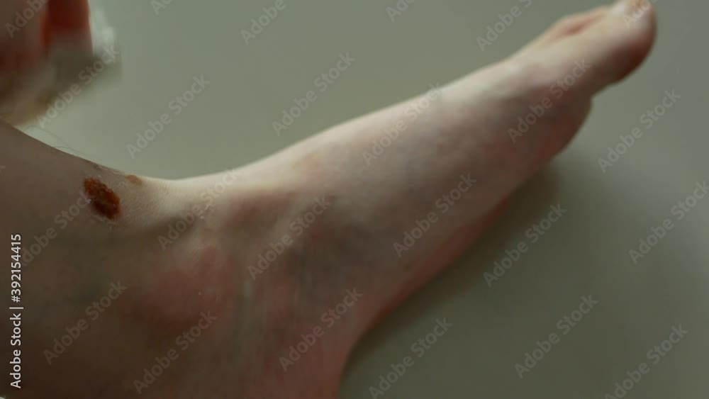 Closeup view of a person hand is scratching a patch of eczema on the leg. Closeup view of a person hand is scratching a patch of eczema on the leg.