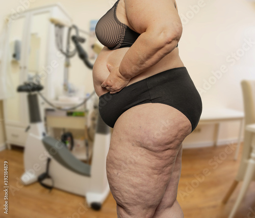 Valokuva Frau mit Übergewicht und Cellulite in einem Behandlungszimmer bei einem Arzt