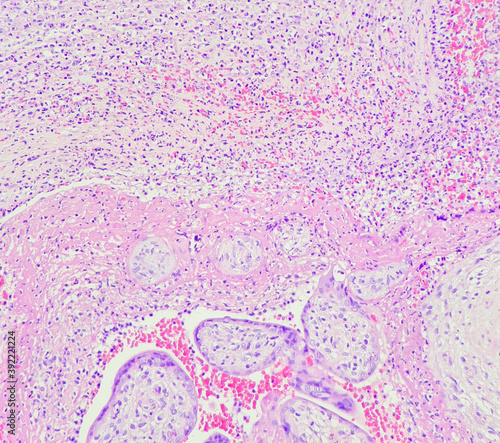 Photo of placenta reveals change of acute chorioamnionitis, magnification 200x, photo under microscope