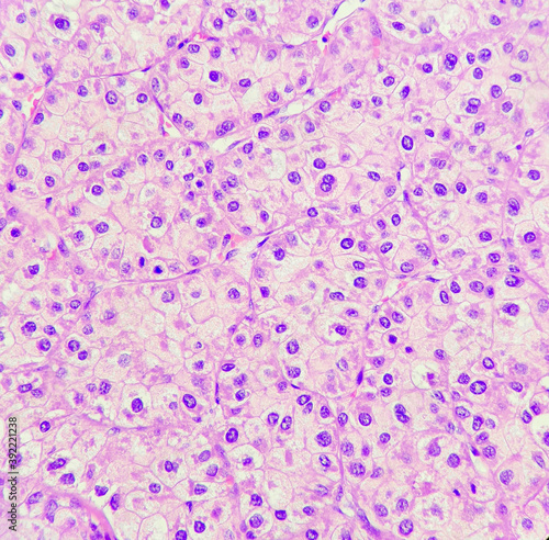 Bilde på lerret This photo reveals hepatocellular carcinoma with trabecular pattern, magnificati