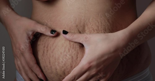 Pregnancy close up of Woman belly skin with heavy stretch wrinkle marks and loose skin after giving birth - Health care and rehabilitation for skin and body shape concept photo