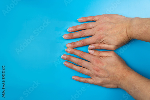 Female hands with nails affected by fungus on a blue background. Hand health and hygiene.