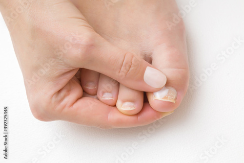 Young adult woman hand using and applying white moisturizing cream on foot nail. Dry, damaged toe nails. Problem and solution. White floor background. Closeup. Front view. © fotoduets