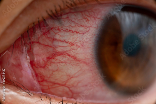 Closeup of irritated or infected red bloodshot eye - conjunctivitis. Red eye of woman, conjunctivitis eye, allergy or after cry.