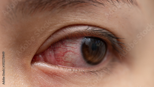 Closeup of irritated or infected red bloodshot eye - conjunctivitis. Red eye of woman, conjunctivitis eye, allergy or after cry.