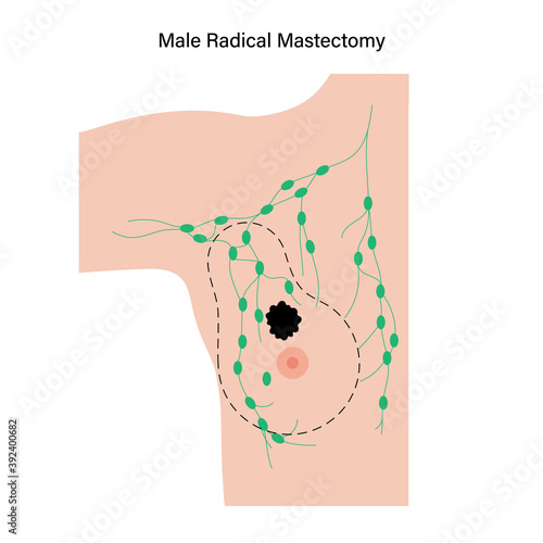 Breast disease concept