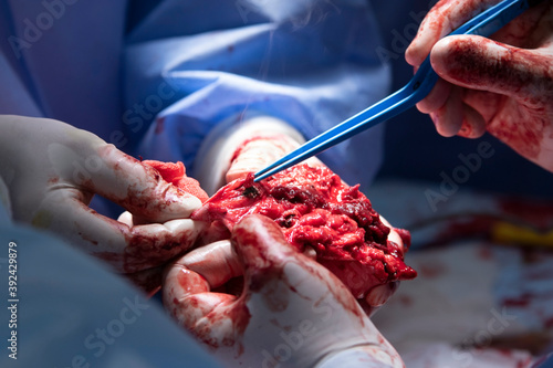 Bilde på lerret Amputation surgery close-up with electrosurgical forceps usage