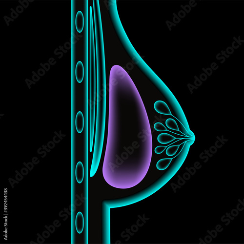 Breast Implant Concept