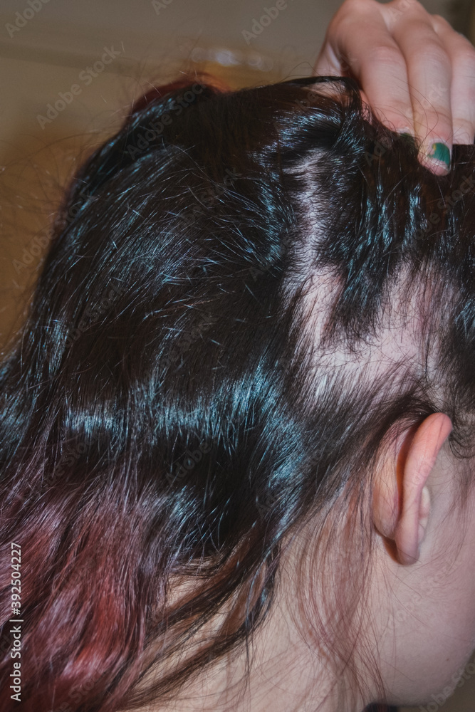 Una mujer joven con la enfermedad de alopecia areata. Concepto de pérdida de cabello Una mujer joven con la enfermedad de alopecia areata. Concepto de pérdida de cabello