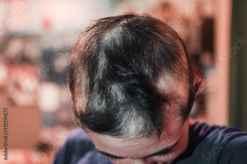 Una mujer joven con la enfermedad de alopecia areata muestra varias calvas en su cabeza. Concepto de pérdida de cabello