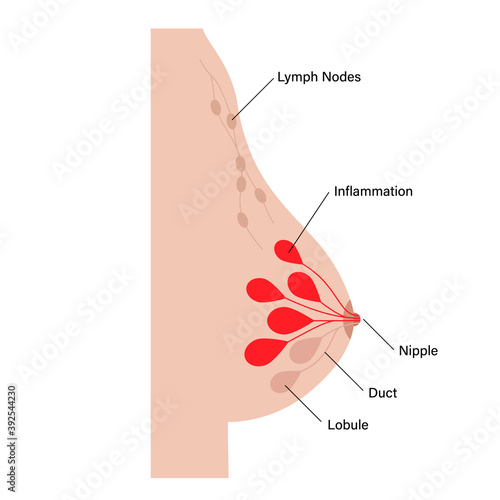Breast disease concept