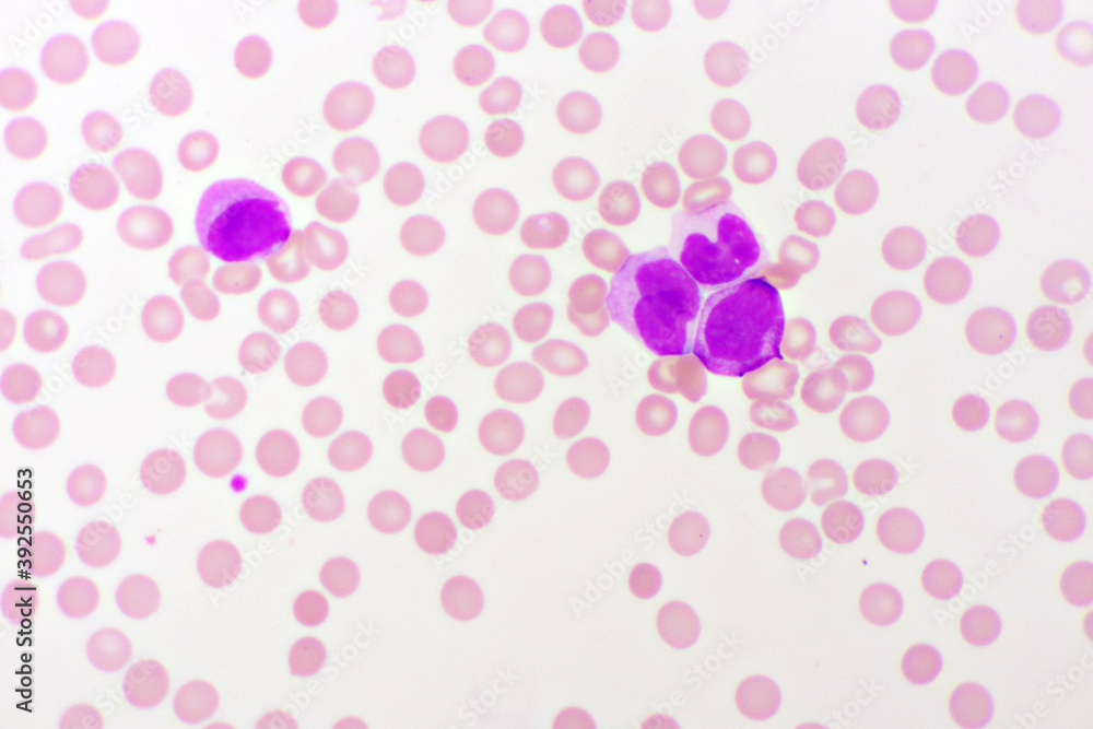 Acute promyelocytic leukemia cells or APL, analyze by microscope