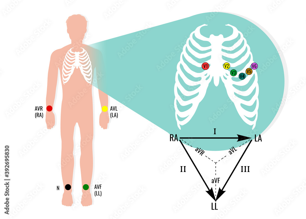 12 Lead Ecg Limb Electrode Placement vrogue.co