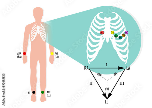 Ecg electrode position illustration with ecg limb leads. Useful for educating doctors and nurses. photo