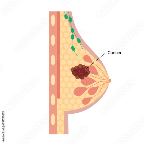 Breast disease concept