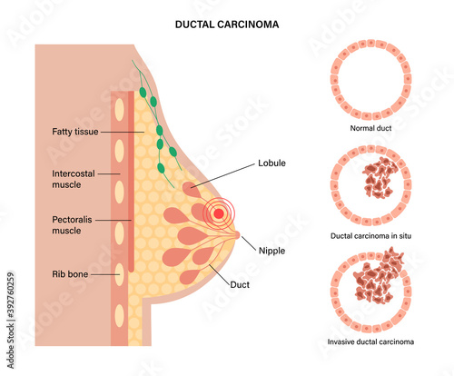Breast disease concept