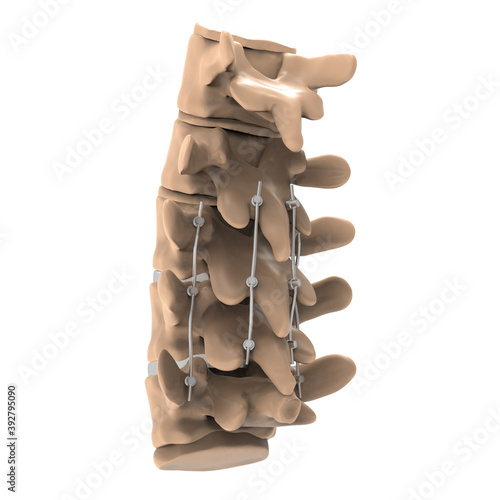 Foto 3d illustration Spinal fixation system - titanium bracket