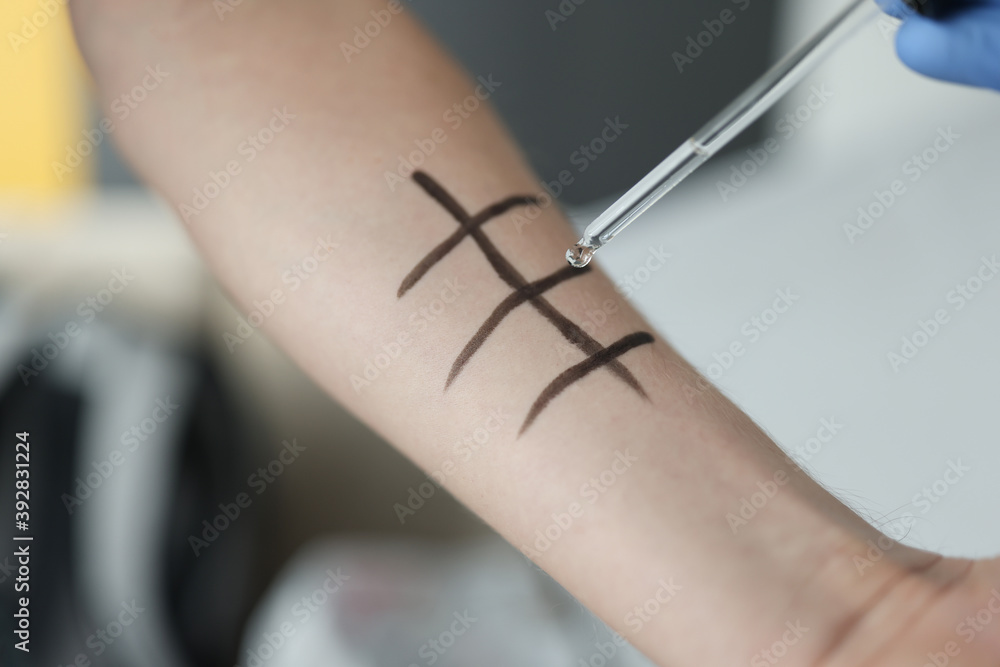 custom made wallpaper toronto digitalOn hand there are markings for testing for allergic reactions. Allergy screening concept