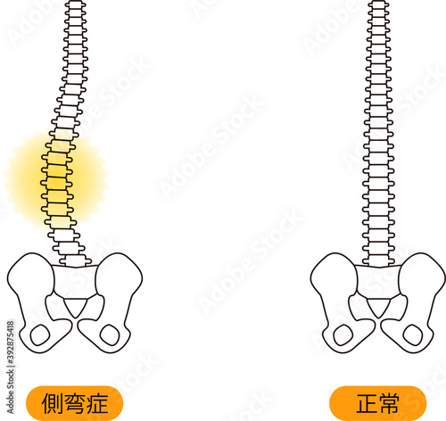 メディカル　姿勢（側弯症） 骨　上半身　背面