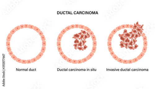 Breast disease concept