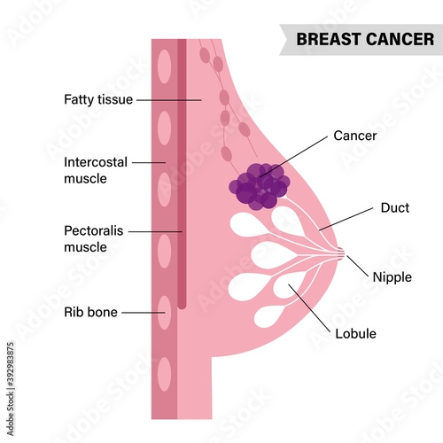 Breast disease concept