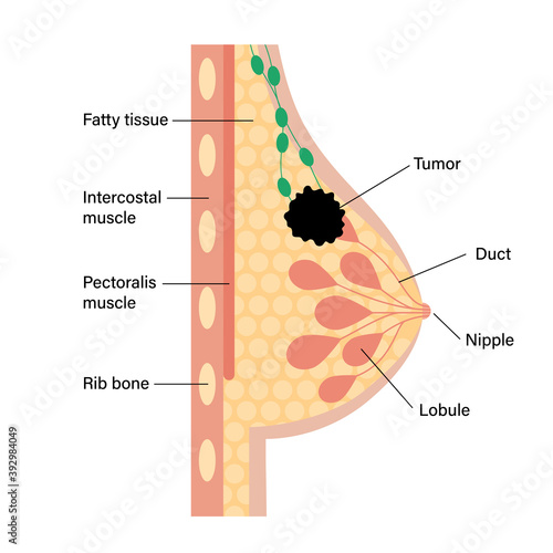 Breast disease concept