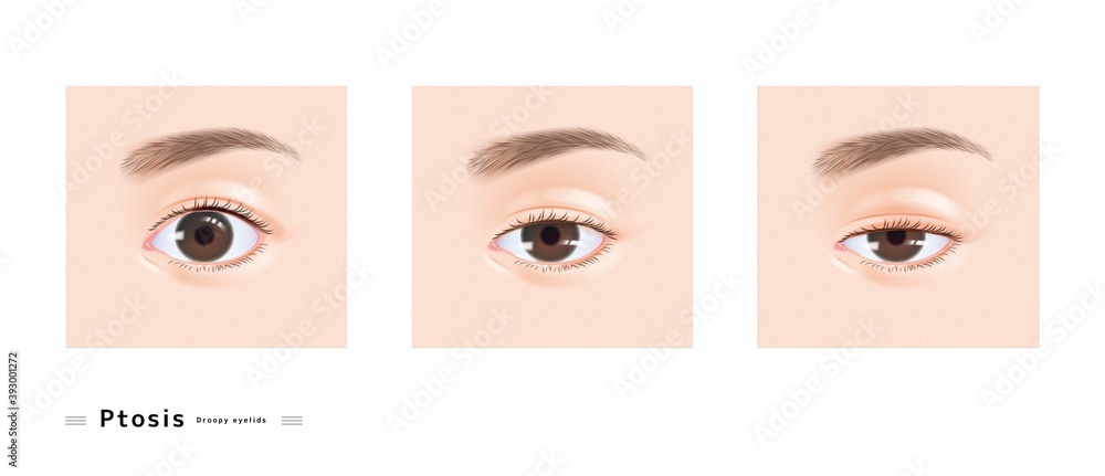眼瞼下垂 女性 顔 目 眠たい まぶた 下垂 眼科 症例 イラスト Vector De Stock Adobe Stock