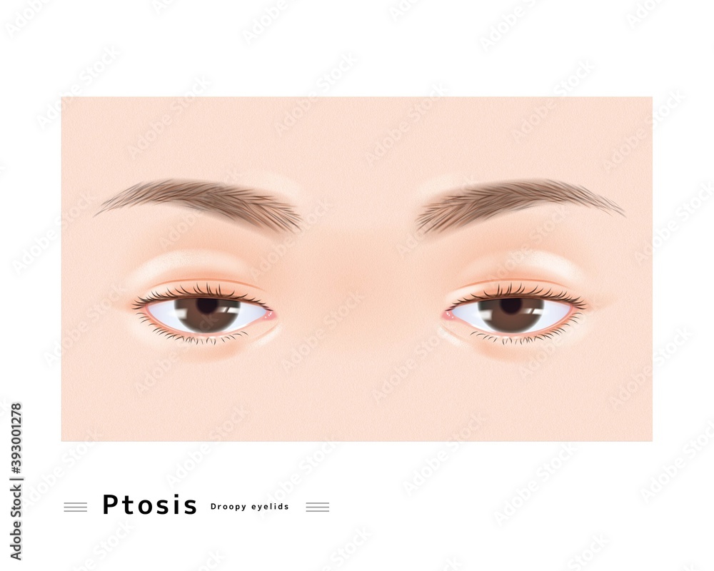 眼瞼下垂 両眼 女性 顔 目 眠たい まぶた 下垂 眼科 症例 イラスト Stock Vector Adobe Stock