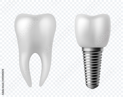 Teeth and implant. Dental surgery human white enamel tooth crown denture orthodontic technology. Artificial teeth dentistry implantation jaw vector realistic stomatology clinic concept