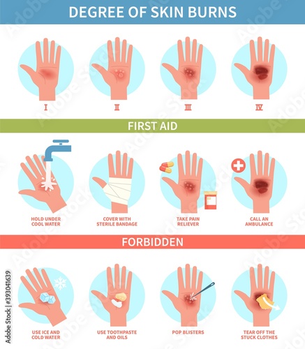 Burns degree. Thermal wound first aid, skin scalds and blisters emergency help. Treatment instruction thermic injury medical guide, information poster help steps flat vector infographic