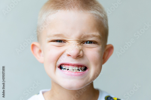 blond-haired boy grimaces, showing braces, close-up
