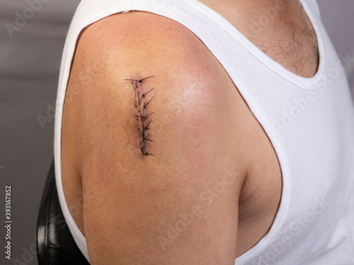 фотографія Surgical incision on right shoulder joint closed with sutures