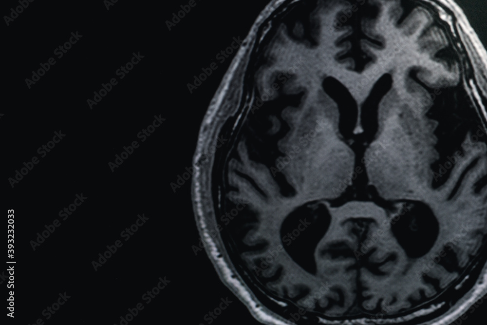 MRI of brain Dementia protocol with Alzheimer's disease Take a picture