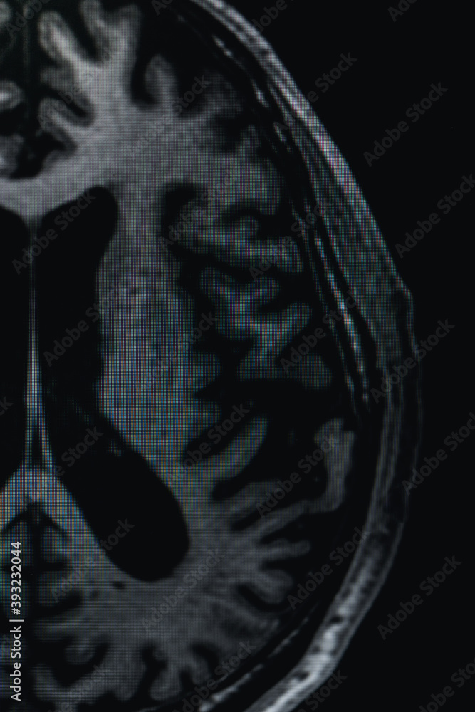 MRI of brain Dementia protocol with Alzheimer's disease Take a picture