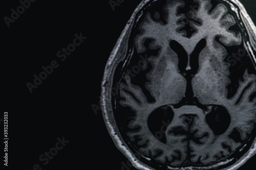 MRI of brain Dementia protocol with Alzheimer's disease  Take a picture from the computer 