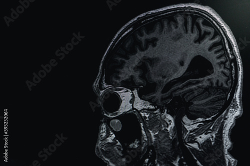 MRI of brain Dementia protocol with Alzheimer's disease  Take a picture from the computer  photo