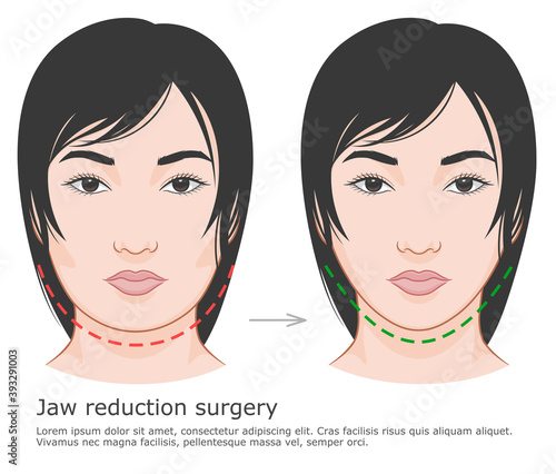 Mandibuloplasty surgery before and after illustration. V-line surgery. Asian woman face.