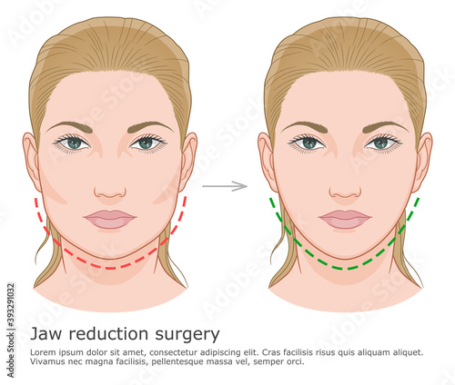 Mandibuloplasty surgery before and after illustration. V-line surgery.