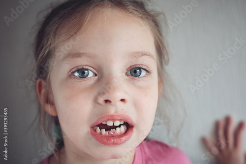 first baby teeth that fell out  portrait of a girl with her front teeth that fell out  children s dentistry