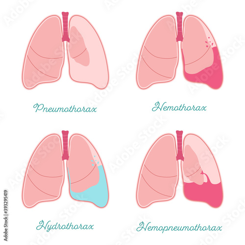 Some types of pleural effusions. Abnormal gathering fluid or air pleural space. Hemothorax, pneumothorax, hemopneumothorax and hydrothorax also. Comparative scheme for patients or medical students photo